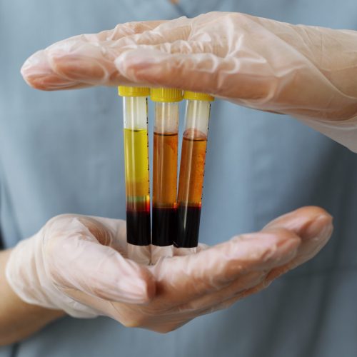 Trombocitemia essencial: o que é, causas, sintomas e tratamento